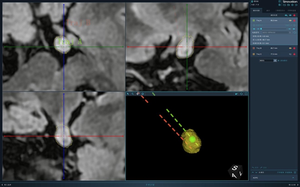 插入腫瘤的2根電極示意圖。重醫附屬兒童醫院供圖