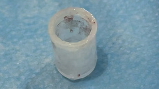 取出的塑料瓶蓋約花生米大小。重慶松山醫院供圖