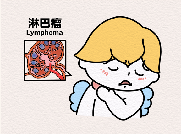 淋巴瘤。重慶松山醫院供圖