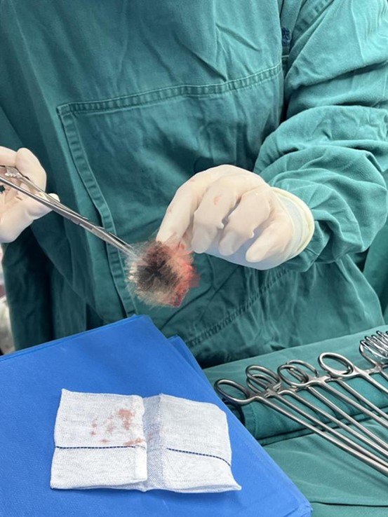 原置換瓣膜周邊已布滿血管翳和血栓。重慶康心醫院供圖