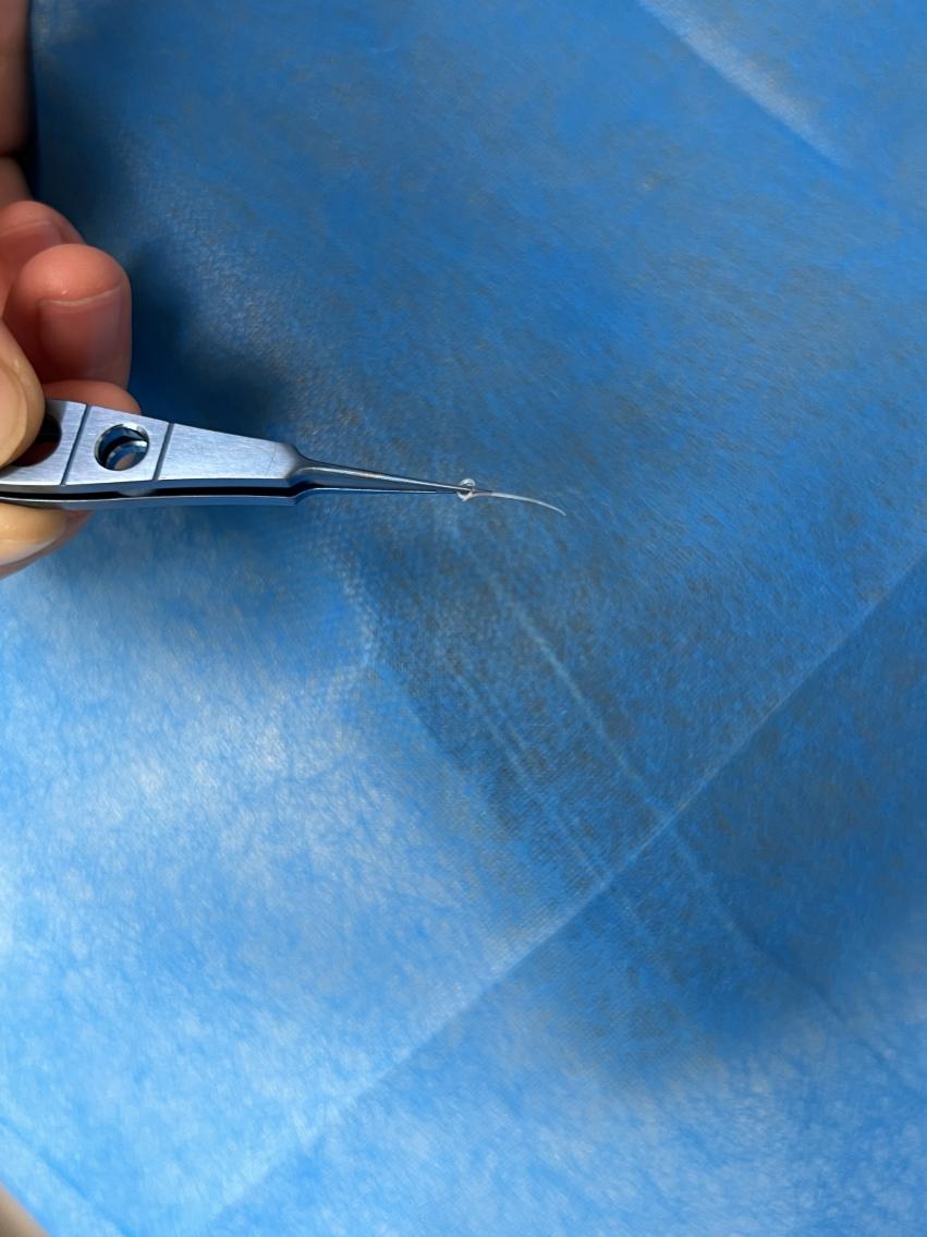 夾出的結膜吸吮線蟲。重慶南坪愛爾眼科醫院供圖