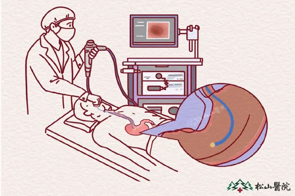 胃鏡檢查。重慶松山醫院供圖
