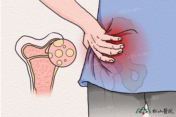 骨髓炎示意圖。重慶松山醫院供圖