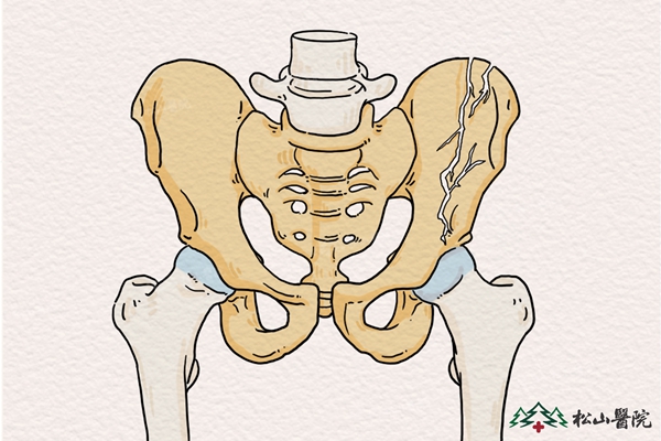 骨盆骨折示意圖。重慶松山醫院供圖