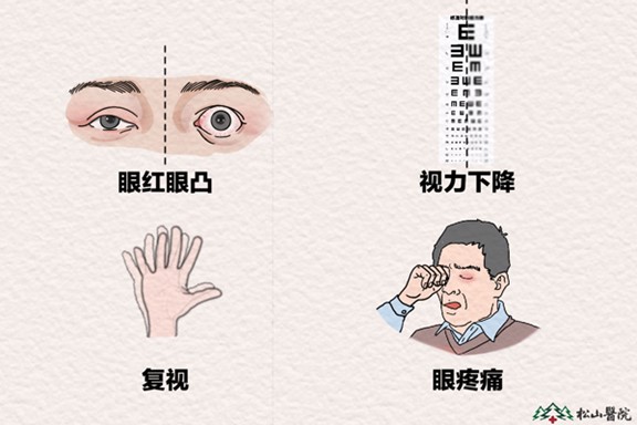 甲狀腺相關眼病的常見癥狀。重慶松山醫院供圖