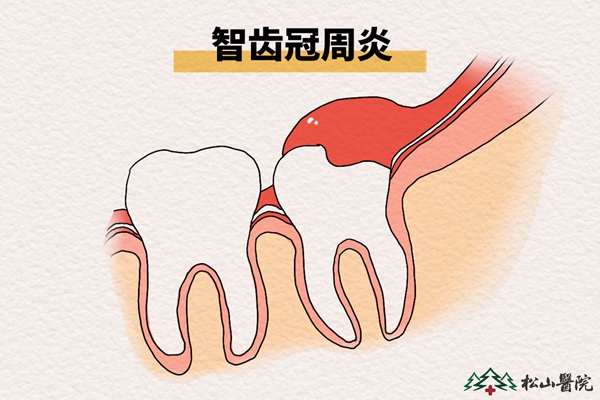 智齒冠周炎。重慶松山醫院供圖