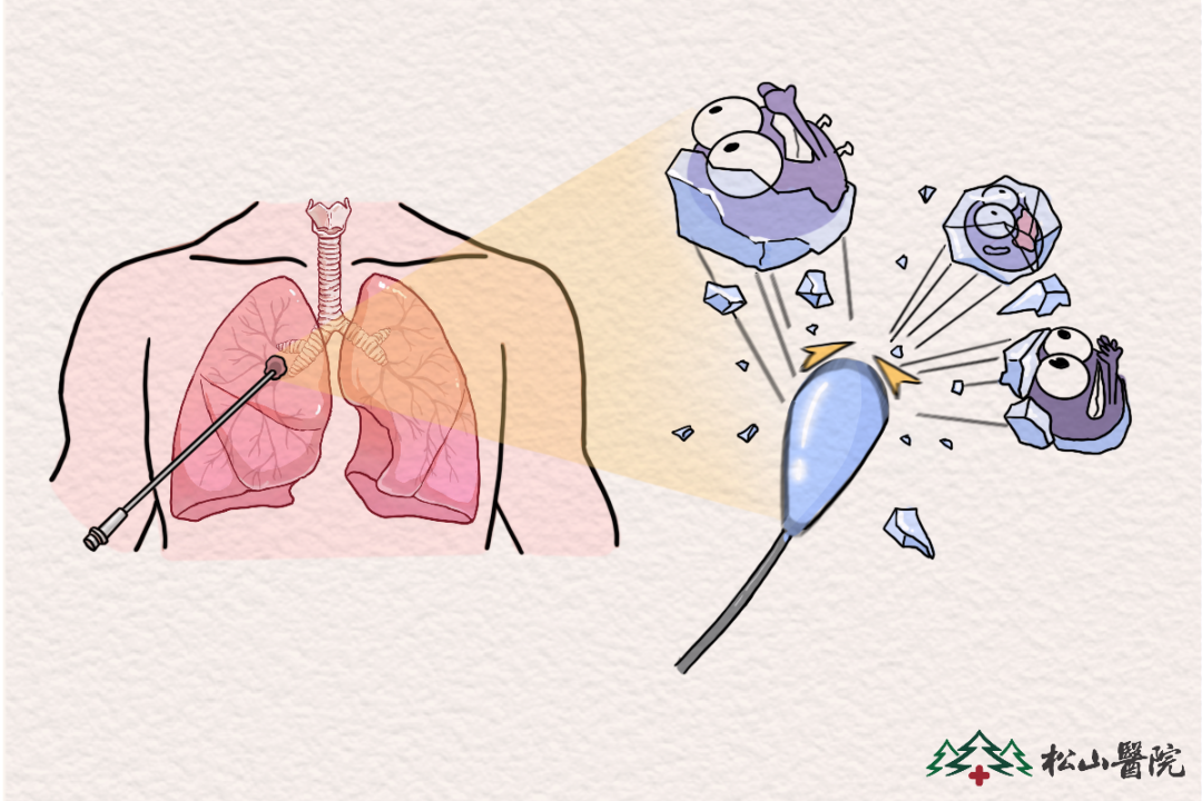 冷凍消融。重慶松山醫院供圖