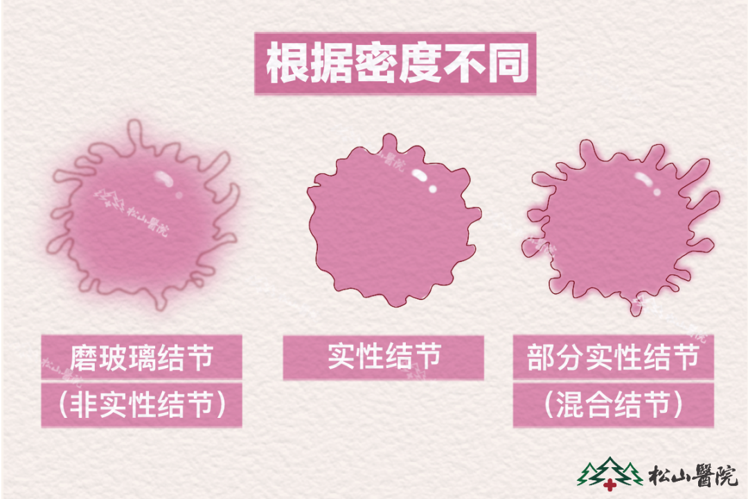肺結節。重慶松山醫院供圖