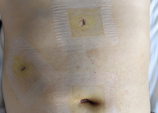 傷口情況。重慶手術醫院供圖