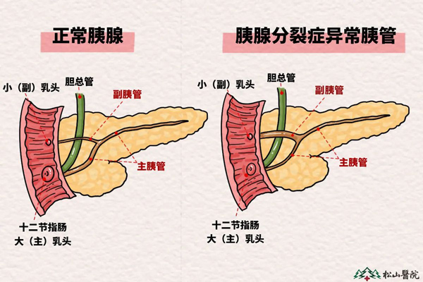 胰腺分裂癥示意圖。重慶松山醫院供圖