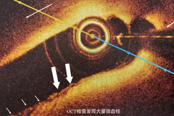 高分辨率光學相干斷層掃描（OCT）技術。重慶醫科大學附屬第二醫院供圖