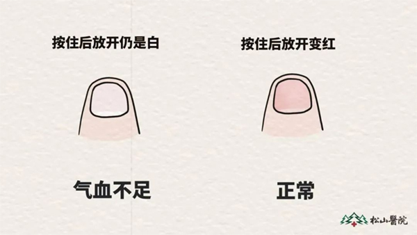 氣血不足與氣血充足時指甲對比。重慶松山醫院供圖