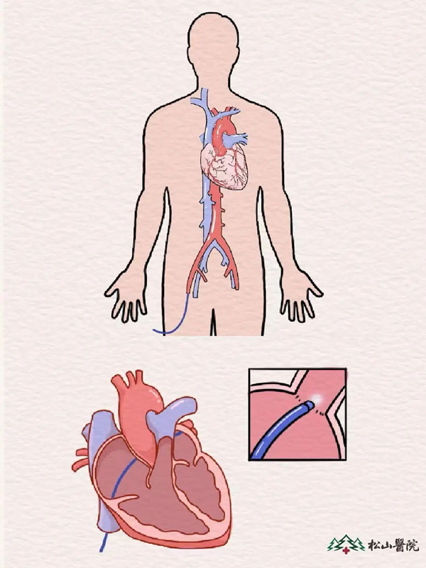 示意圖。重慶松山醫院供圖