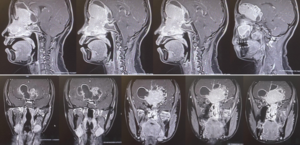 小于術前的磁共振，能夠清晰看到巨大的腫瘤，像豎起的“啞鈴”一樣，連通顱內和鼻腔。重慶醫科大學附屬第二醫院供圖