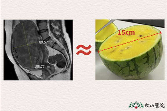 患者子宮肌瘤情況。重慶松山醫院供圖