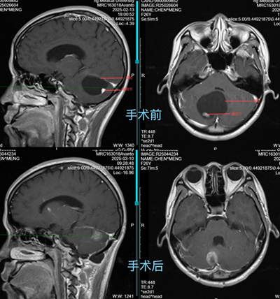 手術前后MRI對比。重醫附屬大學城醫院供圖