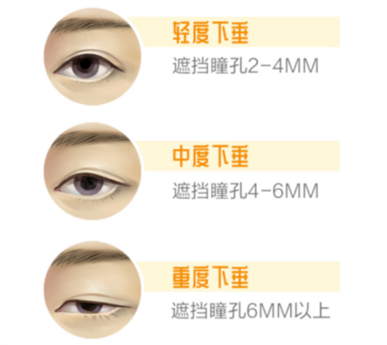 上瞼下垂示意圖。重慶南坪愛爾眼科醫院供圖