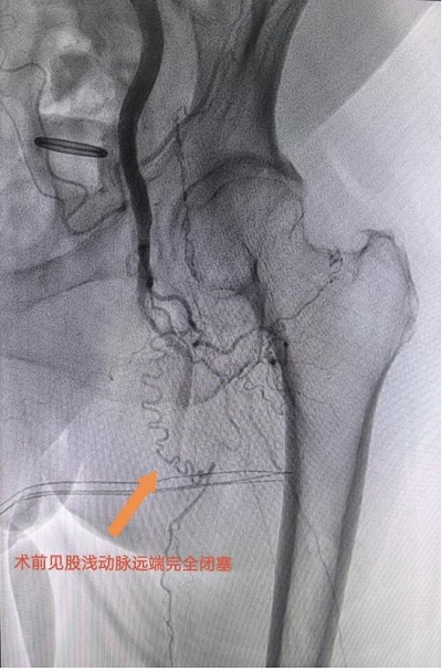 患者左腿動脈血管閉塞嚴重。重醫附屬大學城醫院供圖